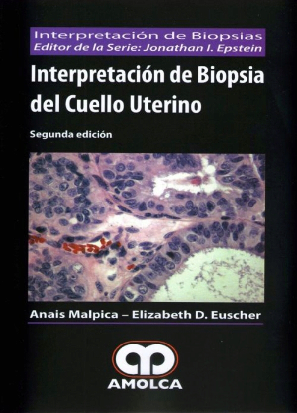 Interpretacion De Biopsia Del Cuello Uterino En Laleo