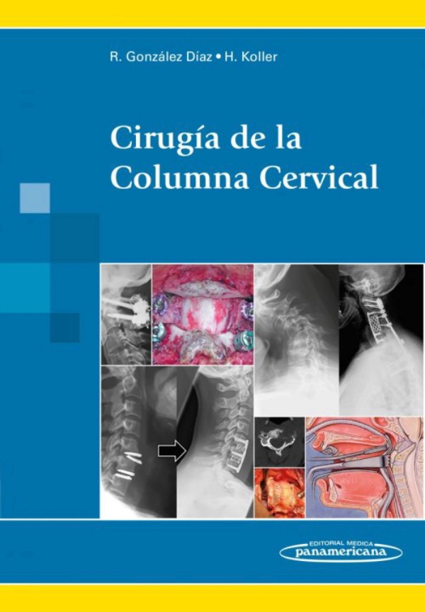 Cirugía De La Columna Cervical En Laleo
